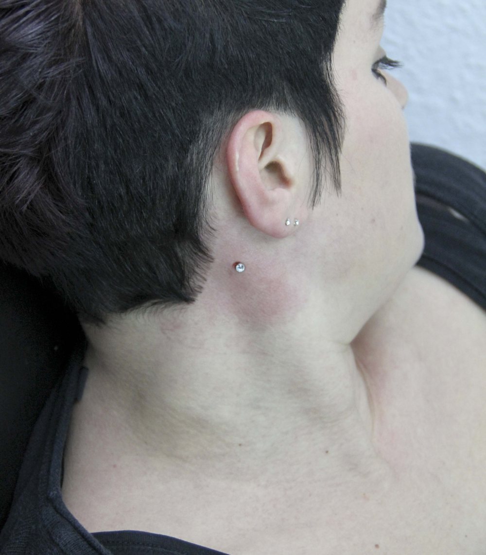 dermal anchor am hals